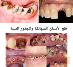 خدمة قلع الأسنان والجذور المتضررة مجانا في كربلاء المقدسة