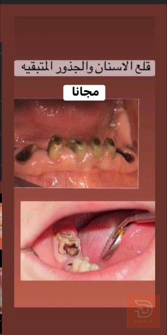مطلوب قلع اسنان مجاني في كربلاء المقدسة