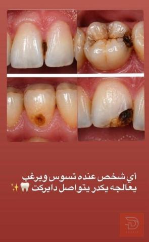 علاج الحشوات الضوئية وحشوات الجذر في كربلاء المقدسة