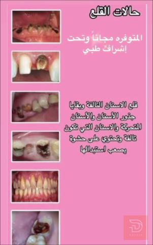 قلع أسنان مجاني في كربلاء المقدسة