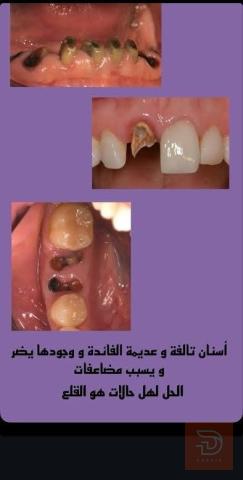 قلع وتعويض أسنان مجاني في كربلاء المقدسة