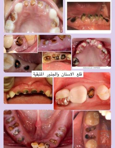 علاج أسنان مجاني - عيادات جامعة أهل البيت في عموم العراق