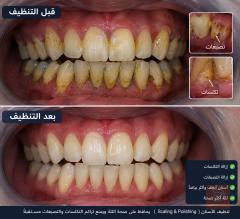 خدمة تنظيف وحشوات وقلع أسنان في عموم العراق