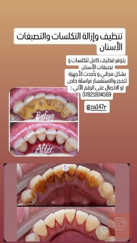 تنظيف أسنان مستعمل في ذي قار