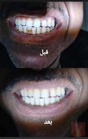 تنظيف أسنان في ذي قار